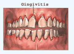 Gingivitis